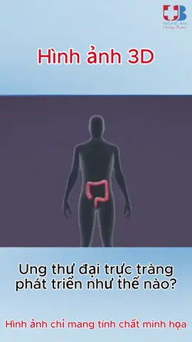 Ung thư đại trực tràng phát triển như thế nào ?#xuhuong #ungthu #ungthudaitrang