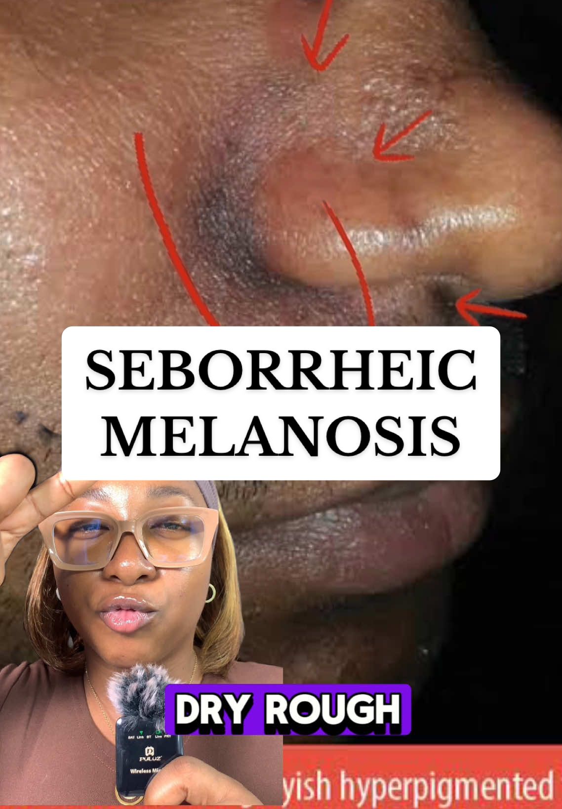 Lets talk about Seborrheic Melanosis. Reference: Verma SB, Vasani RJ, Chandrashekar L, Thomas M. Seborrheic melanosis: An entity worthy of mention in dermatological literature. Indian J Dermatol Venereol Leprol 2017;83:285-289 For Consultation and Product Recommendation, Kindly use the Link in Bio, or send a Whatsapp messsge to 08097167936. Our Consultation Fee is N15,000, with the N3000 discount if you're purchasing from us. Consultation holds from Mondays to Thursdays only. We can't wait to work with you!  #seborrheicdermatitis #seborrheicmelanosis #malassezia #fungalacne #tineaversicolor #shoptadi 