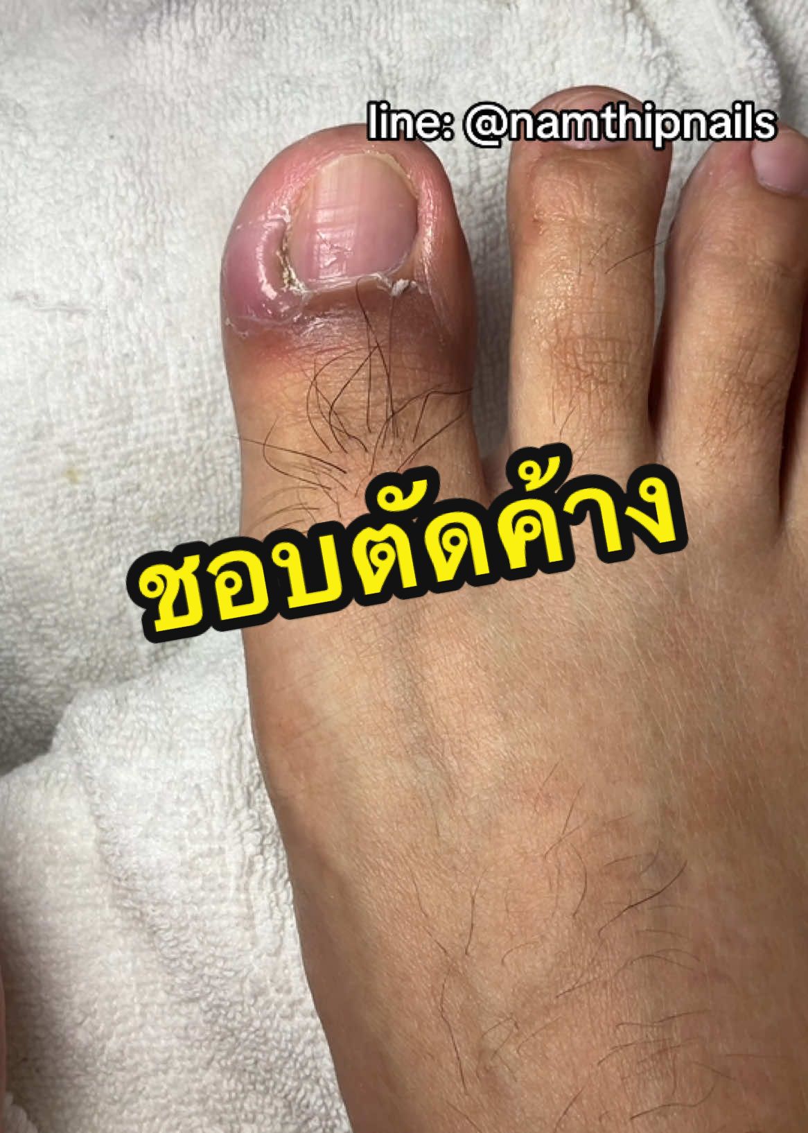 💓 #namthipnails #ตัดเล็บขบ #ตัดหนัง #ทำเล็บ #ร้านตัดเล็บขบ #ร้านตัดเล็บขบราม2 #ตัดเล็บ #เล็บขบ  #เล็บเชื้อรา Fb : namthipnails  Line : @namthipnails  นัมเบอร์วัน8 ตลาดม.ราม2  กทม  Map: namthipnails  https://goo.gl/maps/JmwpCKLfKwmhKGK96  ร้านเปิดทุกวัน เวลา12.00น-22.00น.