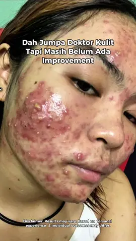 Alhamdullilah hasil sharing & feedback dari @raaezeee ,  Consistent is the Key 🔑 Hasil 1 tahun bersabar, consistent dan guide Healez Skin Expert & Produk Healez Skin Akhirnya Semakin Sihat & Bebas Jerawat.  #Healez #HealezBeauty #treatyourskinright #AcneTreatment #hoclspray #AcneSkincare #healezserum 