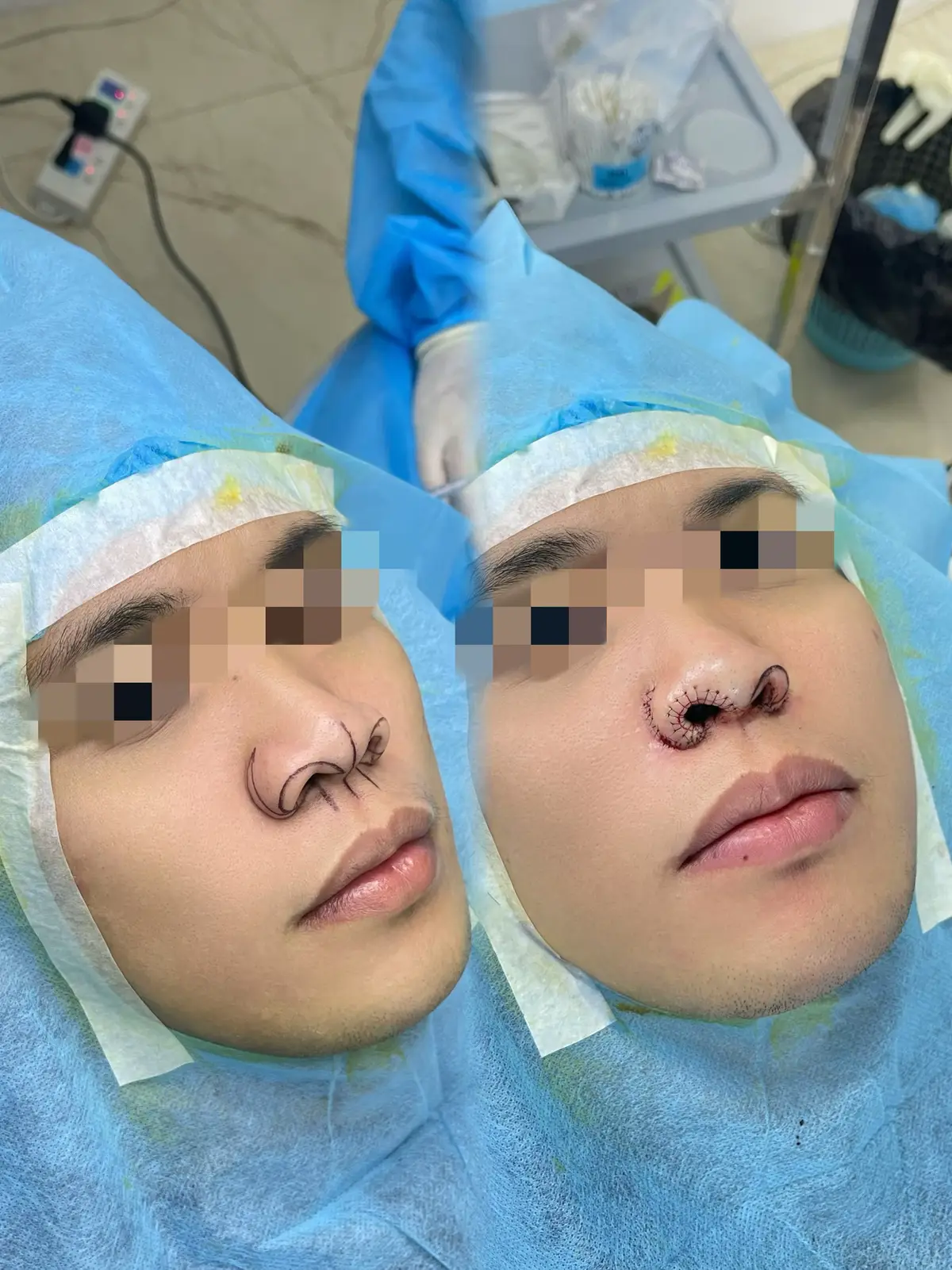 Alar plasty with sexy alar #surgery #trimalar #sexyalar #rhinoplasty #Foxeyes #liposuction 