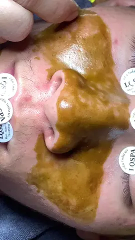 Ôii#chamsocdamun#chamsocdaseo#chamsocdanam#tanbinh#govap #Lequynh#Lqspa#hocnghespa  #chamsocda #lequynhspa #vienthammylqspa #nanmunbangtay #nanmunbangtambong #nanmunbangcay