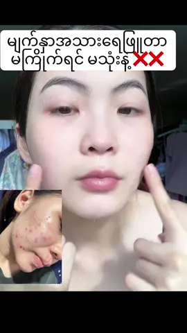 #ဆားဝက်ခြံ #ဝက်ခြံပျောက်ခြင်သူများ #တင်းတိပ်အမဲစက်အတွက် #deleaf #အသားဖြူဆေး #foryou #fyp #foryoupage #thankb4youdo #တွေးပီးမှတင်ပါ 