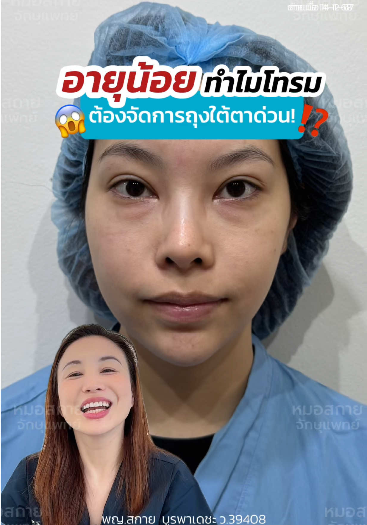 อายุน้อย ทำไมหน้าโทรม🫩 อินฟลูสาว เพลีย‼️ #รีวิวกำจัดถุงใต้ตา #ถุงใต้ตา  ด้วยเทคนิค  #babylock  #กำจัดถุงใต้ตาแผลใน  #หมอสกาย #จักษุแพทย์  #ศัลยกรรมตา #skyclinic #สกายคลินิก #ทำตาที่ไหนดี
