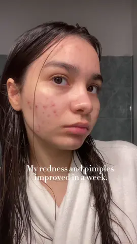 My skin after 1 week with SKIN1004 🌱 My code on Yesstyle: H12092007  #skincare #kbeauty #cuidadocomapele #yesstyle #centella #teatrica #SKIN1004 