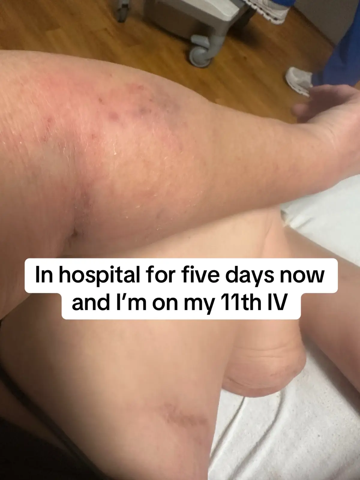 #spoonielife #amputeegirlpower #chrionicillness #mollyjanehitstheroad #anotherhospitaladdmision 