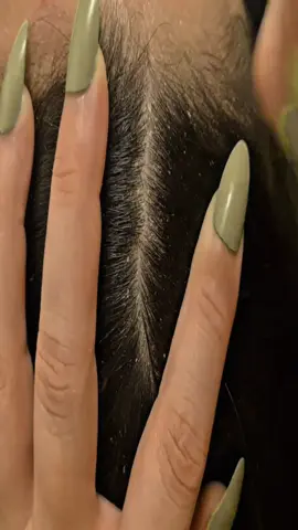 #dandruffscratching #dandruffremovalsatisfying #dandruffremoval #asmrvideo #fypage #satisfyingvideos #psoriasis #capcutedit #capcut #dandruff