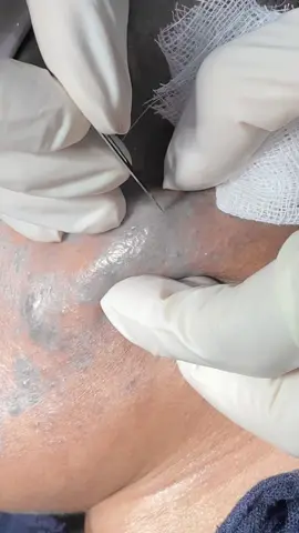 CYST POPPING ON CHEEK #cystpopping 