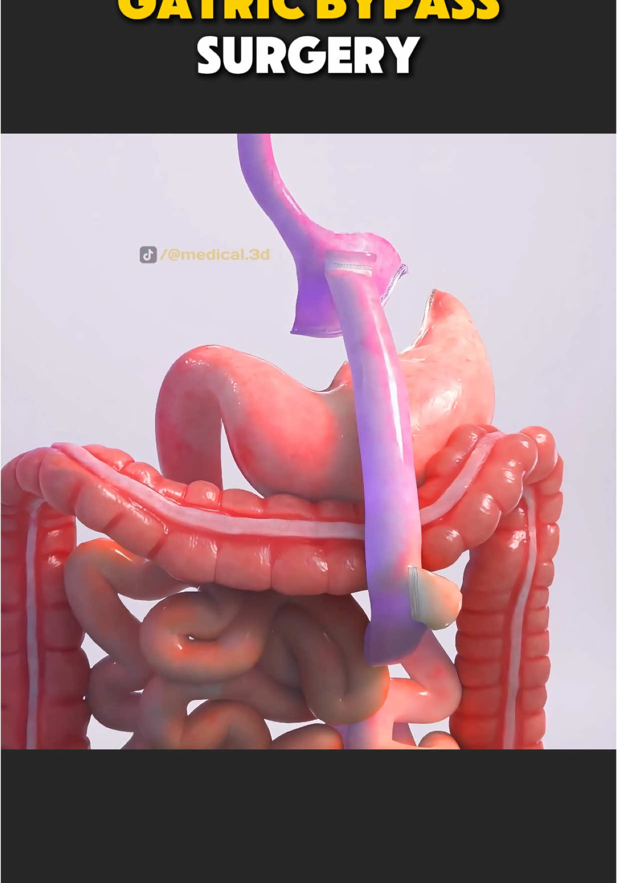 Gastric Bypass Surgery (3D Animation) #gastricbypass #gastricbypassjourney #stomachbypass #stomachsurgey #medical3danimation #3dmedicalanimation #medical3danimation #weightloss #weightlosssurgery 