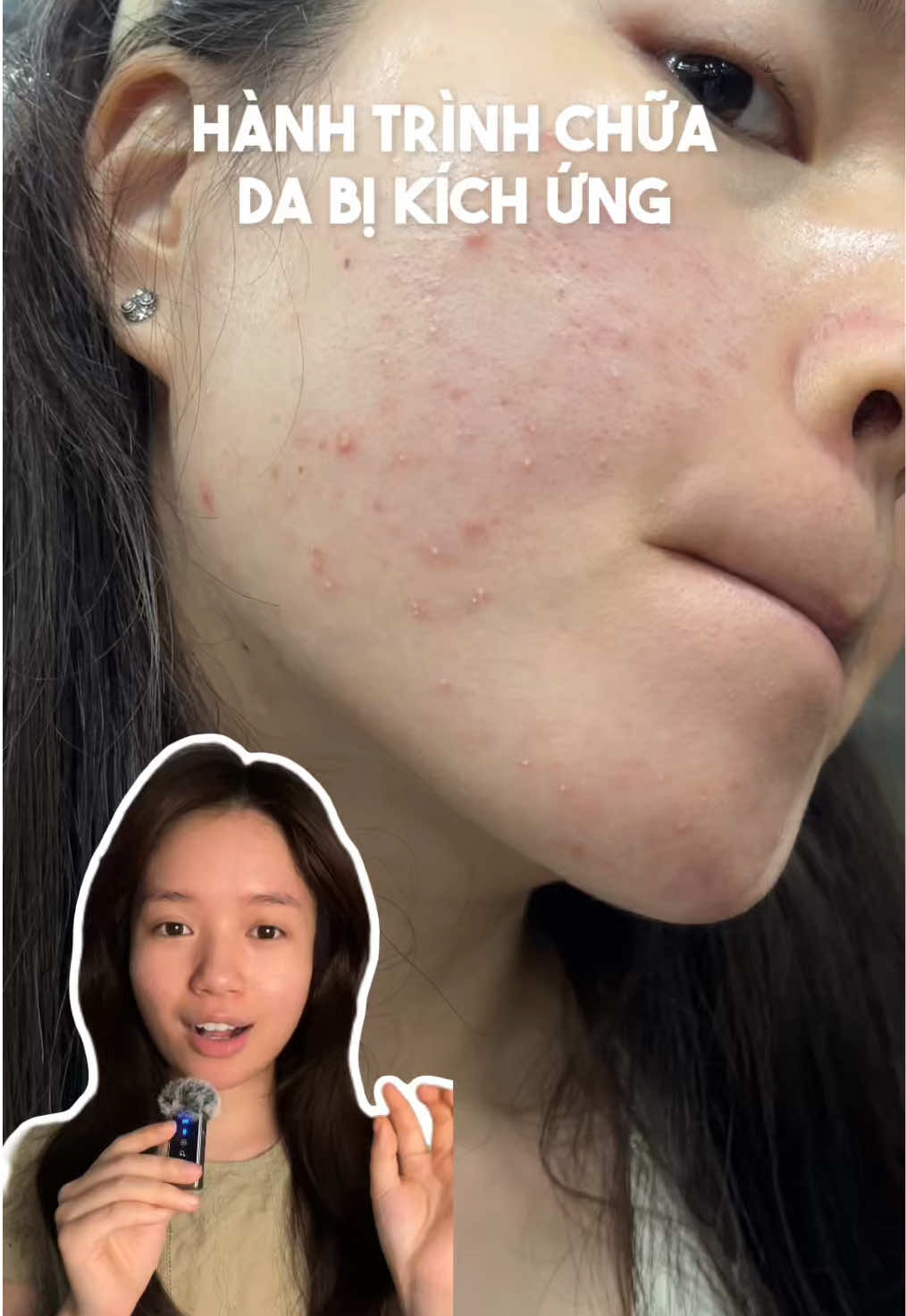 một chút chia sẻ của mình những lúc da hay bị kích ứng và cách mình xử lý, clip 3p hơi dài xíu thui #chamdamun 