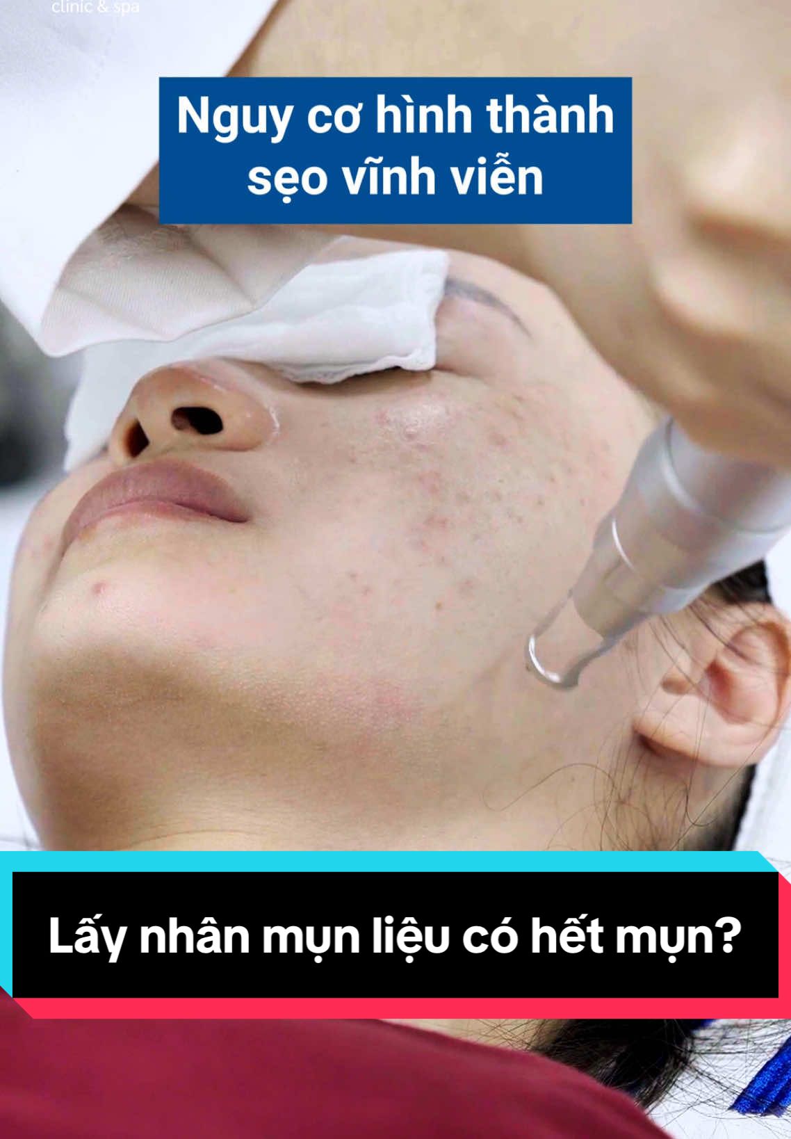 Bạn có thắc mắc tại sao lấy nhân mụn mãi mà mụn vẫn còn ??? Tại sao bác sĩ Pema lại ứng dụng laser trong điều trị mụn ??? #pema #bacsidalieu #muntrungca #laser #dieutrimun 