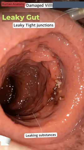 Leaky Gut Syndrome Animation | Digestive System | Immunity and Gut Health | 20#aff #LeakyGut #GutHealth #MedicalScience #Endoscopy #HealthEducation 