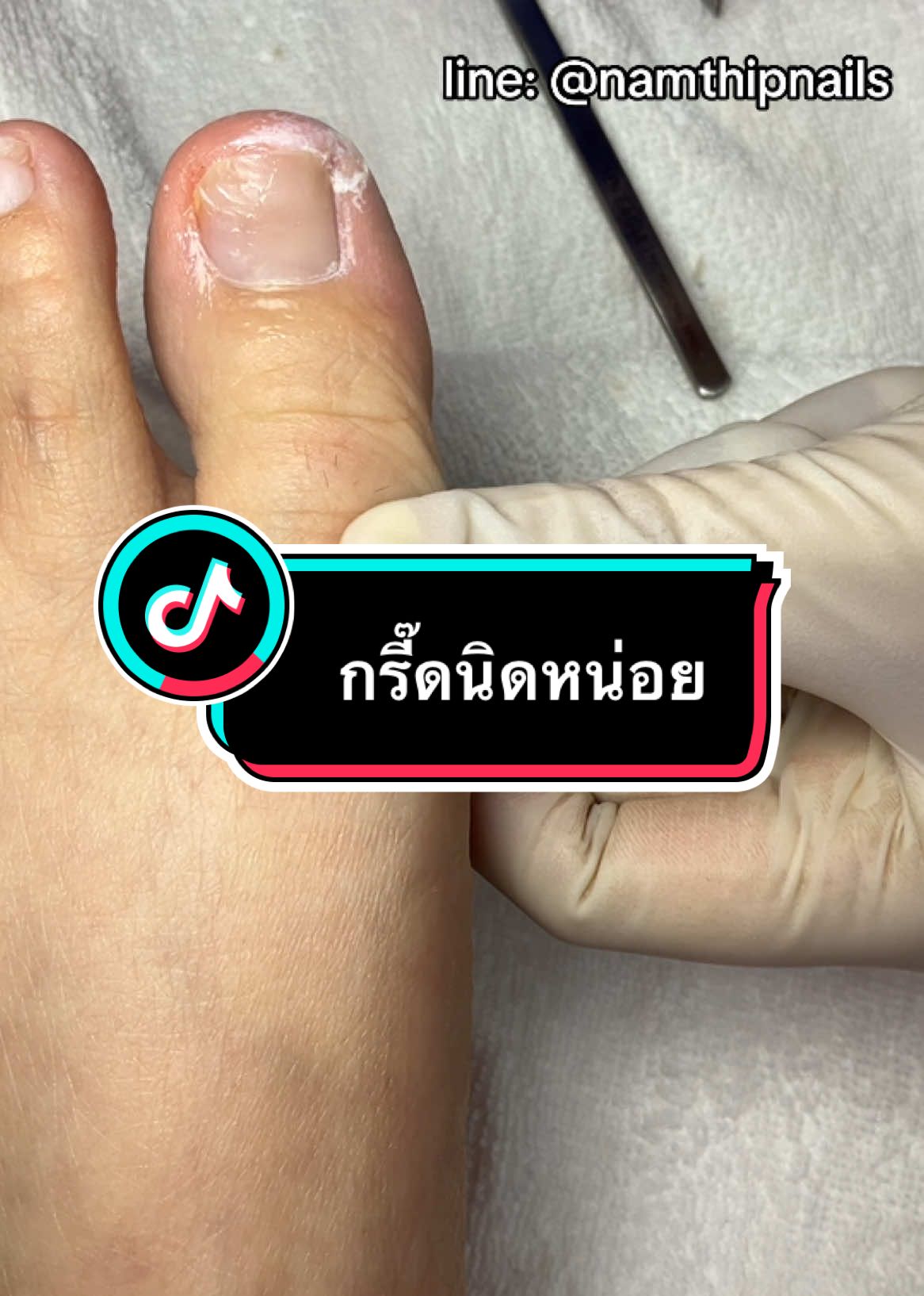 💓 #namthipnails #ตัดเล็บขบ #ตัดหนัง #ทำเล็บ #ร้านตัดเล็บขบ #ร้านตัดเล็บขบราม2 #ตัดเล็บ #เล็บขบ  #เล็บเชื้อรา Fb : namthipnails  Line : @namthipnails  นัมเบอร์วัน8 ตลาดม.ราม2  กทม  Map: namthipnails  https://goo.gl/maps/JmwpCKLfKwmhKGK96  ร้านเปิดทุกวัน เวลา12.00น-22.00น.