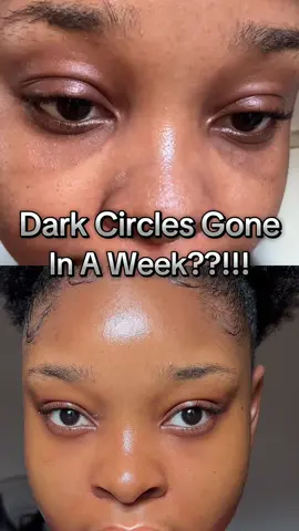 Got rid of my dark circles in a week. @KSECRET GLOBAL Seoul 1988 retinal eye cream claimed to fade dark circles in a week and I tested it #koreanskincare #kbeauty #skincare #skintok #skincareroutine #7days #eyecream #darkcircles #undereyecircles 