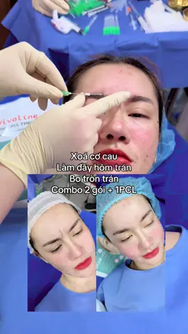 ❤️Thiết Kế Sợi Chỉ Collagen ❤️                 Phục hồi vẻ đẹp của Bạn   _Tặng video  kĩ thuật khi  mua chỉ _Tặng hình ảnh quảng cáo về dịch vụ _Đào tạo Căng chỉ từ cơ bản đến nâng cao _Kết hợp đào tạo và làm dịch vụ với TMV toàn quốc và quốc tế. #ĐàoTạoCăngChỉ , #nâng_cơ_táo #Filler  #Botox   #Mdcode  #căngchỉHQ  #Thắt_Nọng_Cằm #Kéo_Mắt_Cáo #Shanghai #Nâng_Mũi_Chỉ #Cấy_chỉ_cơ_cau , #Cấy_chỉ_đầy_thái_dương #Cấy_chỉ_rãnh_cười , #Tiêm_Môi #TiêmMáBaby  #Tiêm_Meso  #hanhphuc #lamdep #trangda #vivaline  #PTTM #mọingười #All #Bạnbè  #Nêubật#người_theo_dõi  #HCM  #hànội #Đà_nẵng #Cần_Thơ  #China  #Campuchia  