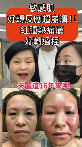 敏感肌崩潰式好轉反應！用了天麗後爆發嚴重紅腫癢痛癢，卻迎來此生最漂亮的皮膚！ #天丽#tenlead #新加坡＃马来西亚#敏感肌 