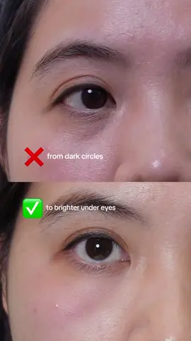 Tired, dark eyes? 😔 This regenerative skin treatment can help improve the appearance of thin, sunken undereyes over time. It works by stimulating collagen production, enhancing hydration, and gradually restoring volume- all while keeping things looking natural. Your glow-up begins beneath the surface.✨  DM us to book a consultation with our nurse practitioner. #undereye #sydneyskinclinic #darkcircles #darkcirclestreatment 