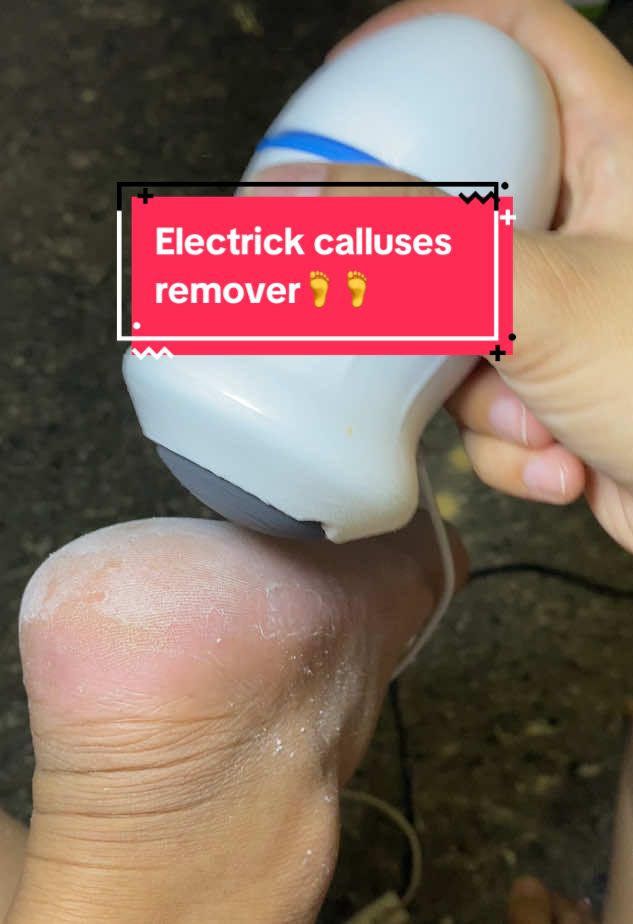Electric calluses super worth it! 🦶🦶 #fyp #callusremoval #asmr 