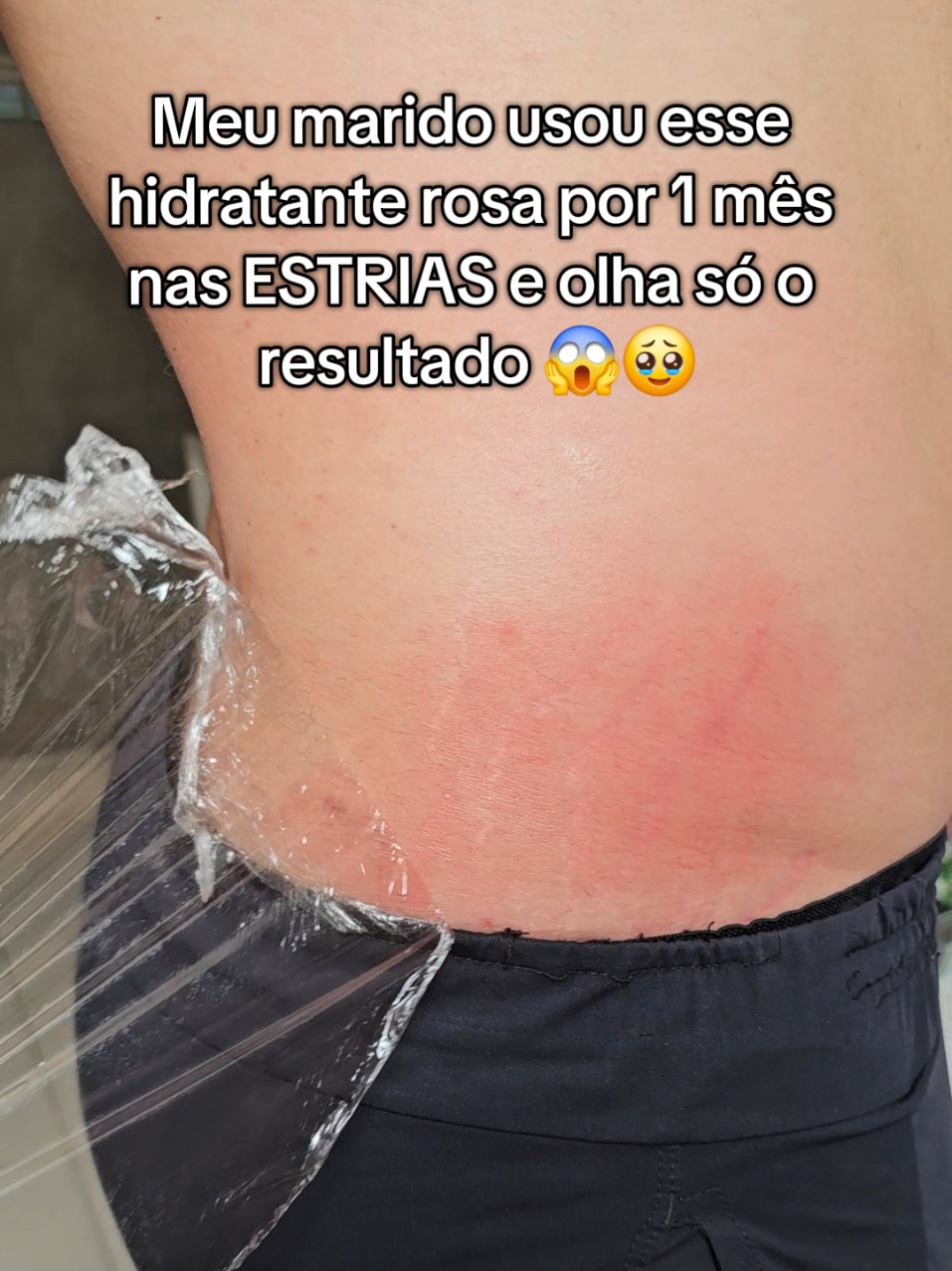 Um mês usando o creme rosa e meu marido conseguiu esse resultado, chocada 😲  #estrias #foliculite #celulite #flacidez #mulheres #mulherbrasileira #brasil #brasileira #cremerosa #marido #maridoemulher 