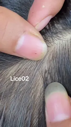 😱#omg #lice #liceremoval 