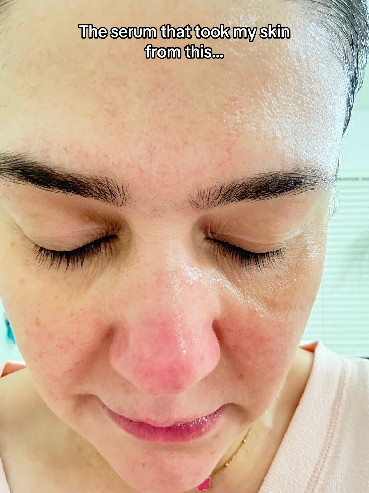 My redness is visibly diminished after using this serum.  @anua_global #anua #anuaazelaicacidserum #azelaicacid #acneproneskin #sensitiveskin #acneskin #acnejourney #acnemarks #acnescars #koreanskincare #skincareroutine #ulta #ultaskintok #sephora