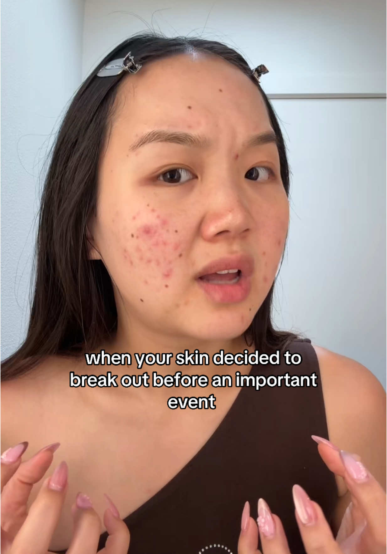 How do they always know? 🥲 #acne #acneproneskin #acneproblems #relatable #clearskin #breakout 