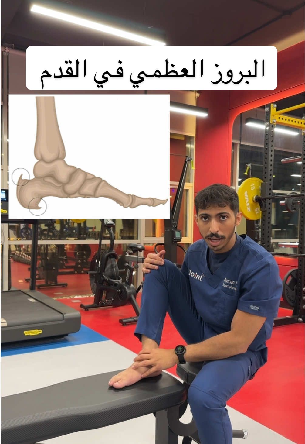 من اشهر الاماكد لحدوث البروز العظمي هو منطقة القدم تصير نتيجة تغير التحميل على الانسجة مع بعض الاصابات او التقدم في العمر ✅ #اكسبلور #علاج_طبيعي #تأهيل #اصابة #التواء_الكاحل #خشونة_الركبة #رباط #اللفافة_الاخمصية #مسمار_القدم #ترند #تمرين #rehab #tiktok #fyp #viral #explore #football 