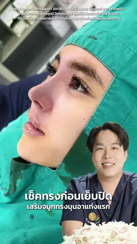 เสริมจมูกแท่งแรก ไวัใจหมอปริ๊นซ์🧑🏻‍⚕️✨ ของเดิมจมูกสั้น ทรงไม่มีมิติ พอเสริมจมูกทรงมุนอาแล้วหน้าหวานขึ้นทันทีเลยค่า🥰#ลูกสาวหมอปริ๊นซ์ #siriwellness #siriwellnessสาขาลาดพร้าว #ศัลยกรรม #เสริมจมูก #ทรงมุนอา #อยากละมุนต้องมุนอา 