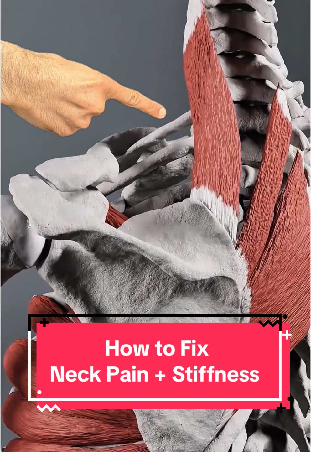 Do you experience pain on one side of the neck near the shoulder blade? Have you noticed that when you turn your head or even look down it feels tight? Check out the link in my bio for my signature neck pain process. Well, one of the muscles right in that area is the levator scapula and when the muscle is tight, it can cause a lot of restriction and pain. However, even more commonly the muscle is elongated because of our bad posture, and that can produce the exact same sensation as when the muscle is tight. So many people just stretch it instead of activate and strengthen it, which can reduce trigger points and allow you to better control movements in the region. Instead of stretching for the rest of your life, try activating your strength, strengthening the levator scapula. #neck #neckpainrelief #neckpaintreatment #levatorscapulae #shoulderpain #headaches #tmj #spine #shouldermobility
