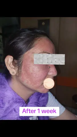 Dont wait, Don't rely on your home remedies nor on your nearby medical store. Your solution to every skin problem is just a consultation away. Dr Chandra Mohan Sah, Senior Dermatologist  Yeti Skin And Hair Clinic Puspalal Park  Butwal 9748845430 #skincare #best ##fyp #skindoctor #butwalmuser #hairdoctor #drchandramohansah #yetiskinandhairclinic #skincaretips #follo #allergy #creatorsearchinsights @YetiskinPHARMACY @Buddha Skin Care 