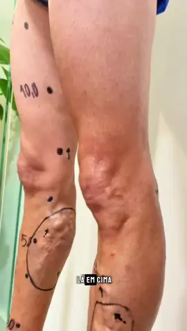 VARIZES GROSSAS = o Antes e Depois que vocês tanto gostam 😍 Publicação de caráter educacional e que não configura promessa de resultado diante da individualidade de cada paciente. Técnicas, percepções e resultados variam conforme as particularidades de cada paciente e somente o médico especialista pode estabelecer o planejamento terapêutico, ocorrendo em consulta o alinhamento de expectativas, apresentação de benefícios e riscos. Imagens completamente reais produzidas na @angio_face sem melhoramentos tecnológicos, não podendo ser utilizadas por terceiros sem autorização expressa.  Dr. Fábio Guilherme Médico Cirurgião Vascular CRM 3049-SE/RQE 2335 Quer falar comigo? Clique no link da bio.