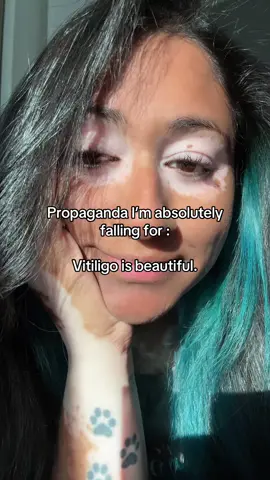 You’re a work of art babe 🫶🏽🥹 #vitiligo #propagandaimfallingfor #vitiligoawareness #skinpositivity #vitiligobeauty 