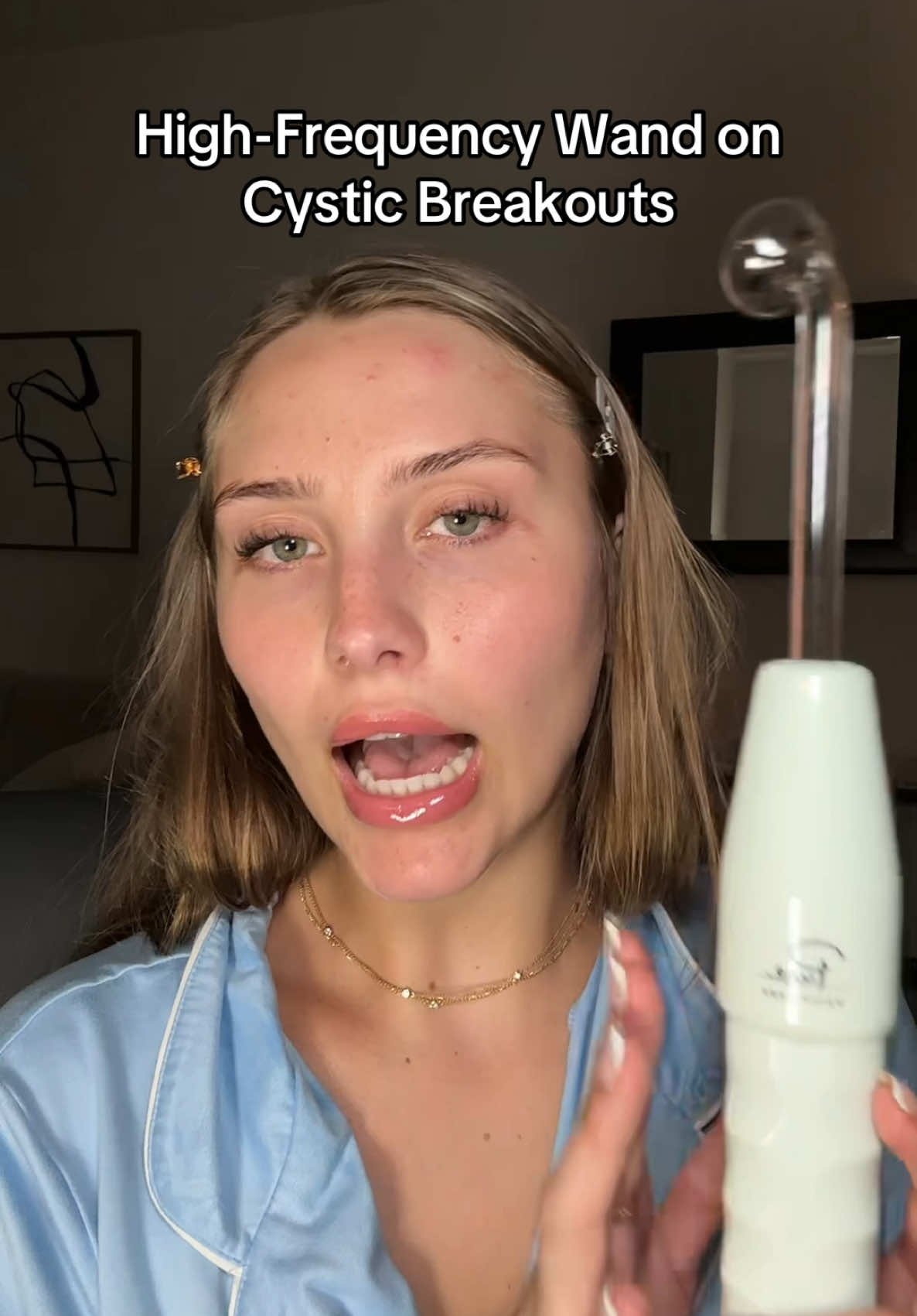 I think one of my hair products is breaking me outttt with this high frequency wand is a lifesaver #highfrequencywand #skincareroutine #acneproneskin #hormonalacne 