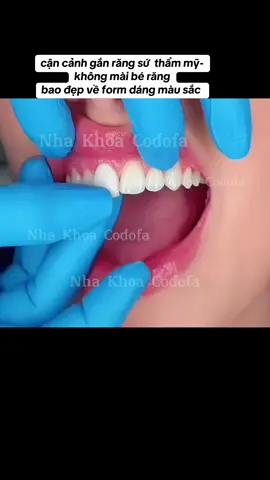 cận cảnh gắn răng sứ  thẩm mỹ- không mài bé răng bao đẹp về form dáng màu sắc - đỉnh chóp ạ #răng_sứ_thẩm_mỹ  #nhakhoacodofa #dánsứveneer #khôngmài_nhỏ_răng #trám_răng_thưa #trám_răng_sâu #trám_tam_giác_đen #trámrăng_sứt_mẻ #trámmòncổchânrăng #cầurăngsứ 