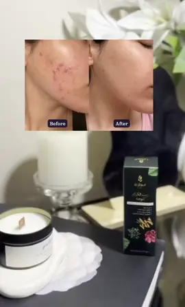 هل تعانين من البقع والجلد الخشن؟ استعيدي جمالك الطبيعي الآن! 🌸 💛 زيت الكركم للوجه – طبيعي 100% 🌿 يحتوي على الكركم النقي، خلاصة الورد وزيت الجوجوبا ✨ يقلل البقع، يصغر المسام، ويمنح بشرتك نعومة وإشراقة 💧 يرطب بعمق ويقلل التجاعيد 👩‍🦰👨‍🦱 مناسب للنساء والرجال! 🔥 احصلي عليه الآن بخصم 61% – لفترة محدودة فقط! 📸 شاهدي التقييمات والصور هنا: https://usturataljamal.com/products/turmeric-facial-oil امنحي نفسك هدية من سحر الطبيعة! 🌿
