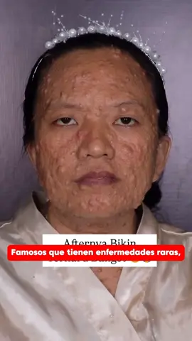 famosos con enfermedades raras #estadosunidos🇺🇸 #famous #usa #actors #eeuu #movies #hollywood 