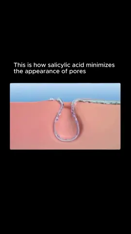 Salicylic acid is a beta-hydroxy acid (BHA) that penetrates deep into the pores due to its oil-soluble nature. It dissolves excess sebum and exfoliates inside the follicle lining, helping to clear out debris and reduce pore congestion. Over time, this makes pores appear smaller and skin look smoother. Ideal for oily and acne-prone skin types. #skincare #skincareroutine #salicylicacid #pores #acnetreatment #skincareingredients #SkinCare101 #beautytips #glowingskin #scienceofskincare #skincarescience #dermatologistrecommended #reels #fyp 