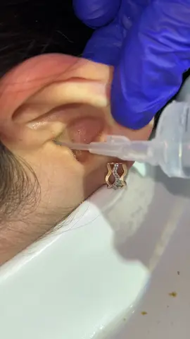 Серная пробка👂 #лоралибековна#рекомендации#лорастана