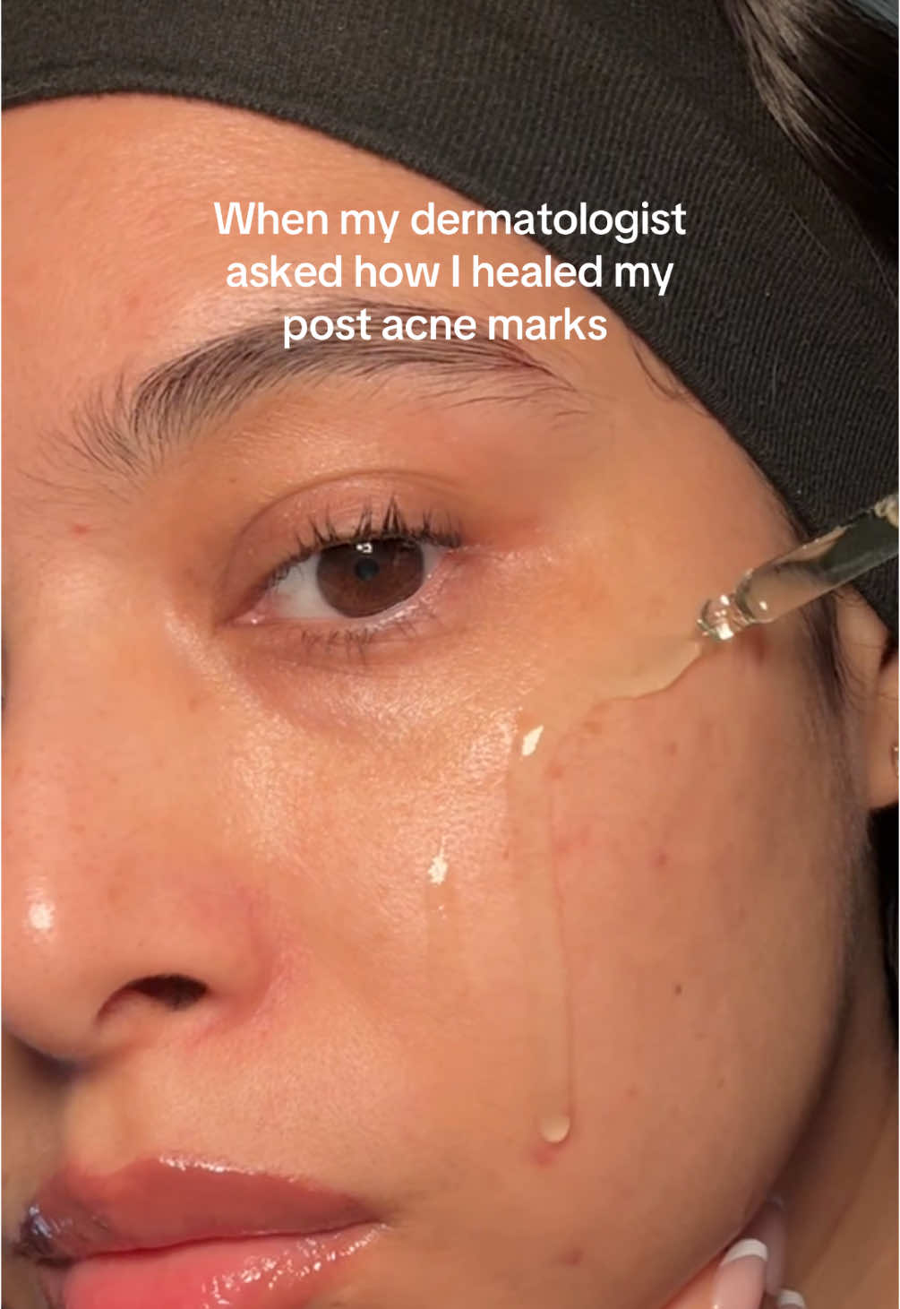 ✨ Azelaic Acid: The Underrated Glow Giver ✨ If you struggle with acne, redness, or uneven skin tone, azelaic acid might just be your new girl.🙌🏽 🧪 What is it? A gentle, multitasking acid naturally found in grains like barley and wheat. Dermatologist-loved for a reason! 💥 What it does: ✔️ Kills acne-causing bacteria ✔️ Reduces redness and inflammation (rosacea-friendly!) ✔️ Fades dark spots and post-acne marks ✔️ Gently exfoliates for smoother skin 🌿 Sensitive-skin approved Unlike many exfoliants, azelaic acid is non-irritating and pregnancy-safe. Perfect for those who want results without the sting. 🦂  #azelaicacid #skincare #skintransformation #kbeautyskincare #postacnemarks #hyperpigmentation 