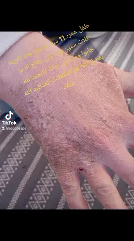 الحمد لله رب العالمين هذا الطفل صار معه اكزيما ثلاث سنوات عجز من الأدوية  ولا يوجد نتيجة  والحمد لله بفضل المكملاتDXN النتيجة رائعه#علاج_طبيعي #تركيا🇹🇷اسطنبول #العراق🇮🇶 #قطر #السعودية #مصر ##دبي #المغرب🇲🇦تونس🇹🇳الجزائر🇩🇿 #الكويت #الاردن #كندا #ليبيا #سوريا #اليمن_صنعاء_ #لبنان 