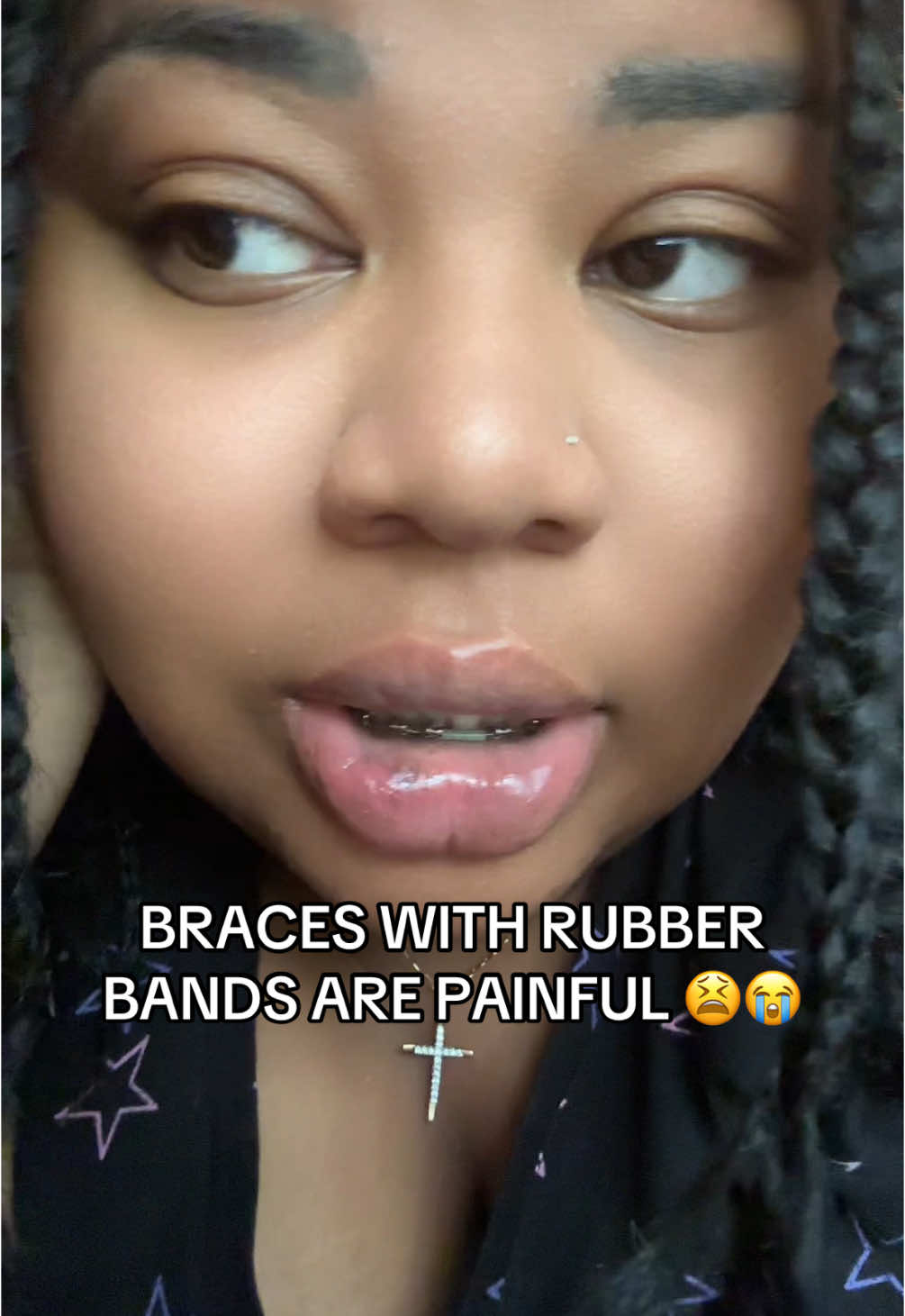 #braces #fyp 
