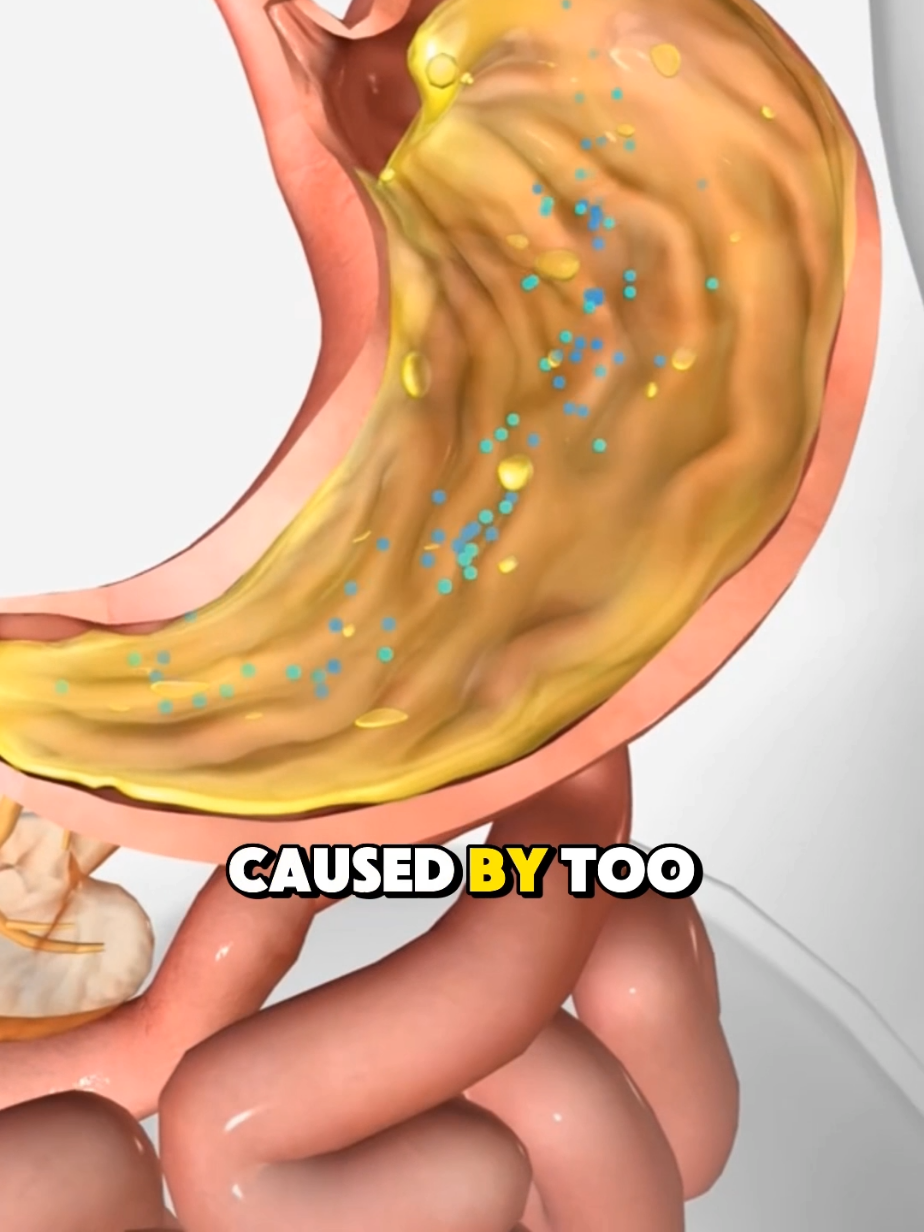 Stomach Ulcer Warning Signs You Shouldn’t Ignore #stomachulcer #UlcerSymptoms #gastriculcer #pepticulcer #DigestiveUlcer #stomachpainrelief #ulcerawareness 