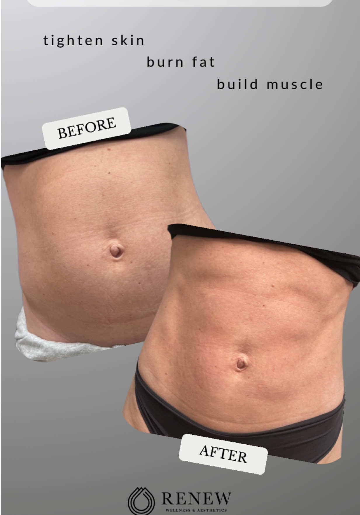 Tighten skin, burn fat and build muscle with zero effort! 💪🏼 #renewoklahoma #emsculptneo 