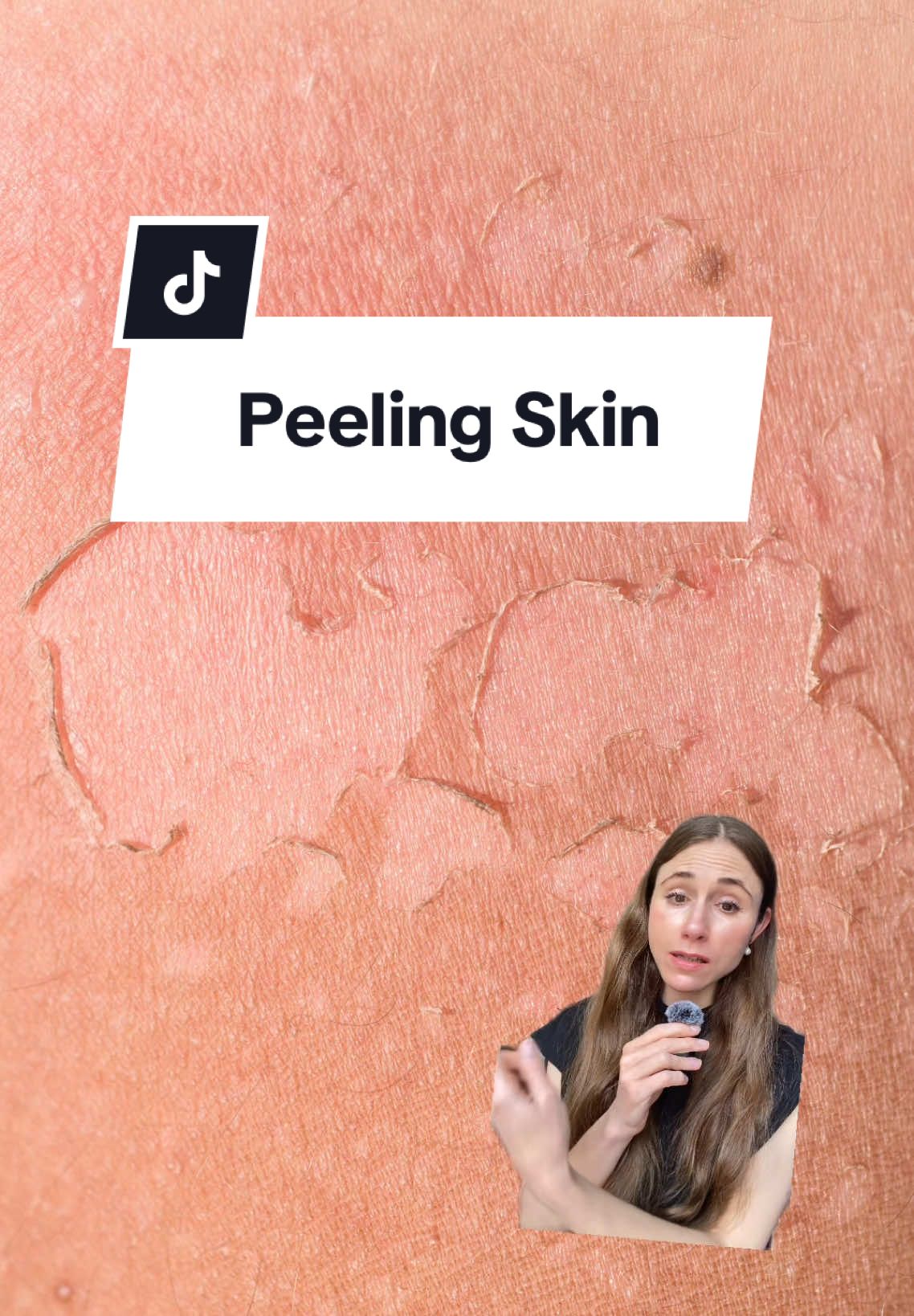 How to get rid of peeling skin from the sun.#sunburn #sundamage #peelingskin #dermatologist #creatorsearchinsights 