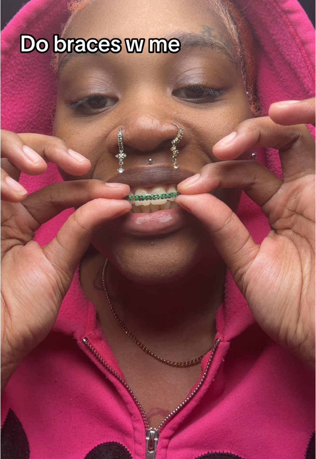 Do braces w me 🤷🏽‍♀️💕#fypppppppppppppppppppppppppppppppp #explo #relatable #fakebraces #cliponbraces #fakebracesgirl💓 