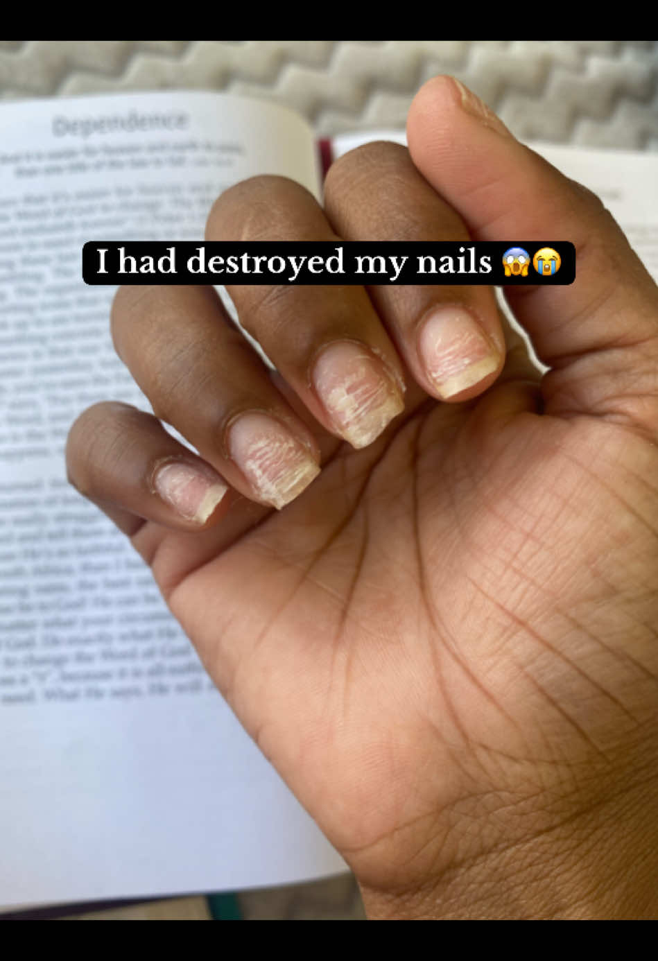This serum saved my nails because I thought my nails will never be strong again 😭. Applying twice a day and being intentional with my nails care habits , no more using nails as tools . Link in bio, just WhatsApp us to grow healthy nails. #nailtransformation #nailgrowth #GlowUp #nailserum #recoveringaddict #naturalnails 