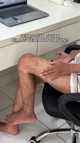 PUNYA BEKAS LUKA BERTAHUN-TAHUN😭 Yang punya bekas luka sini deh merapat! Cobain Chamomile Cream yang bisa bantu rawat kulit kamu✨ Siapa nih yang udah pernah coba? Komen dong di bawah hasilnya di kulit kamu👇🏻 #Ciara #CiaraIndonesia #BekasLuka #Ruam #PenghilangBekasLuka #CreamBekasLuka #CreamGatal #PenghilangGatal #creamlritasi  #PertolonganPertama #fyp 