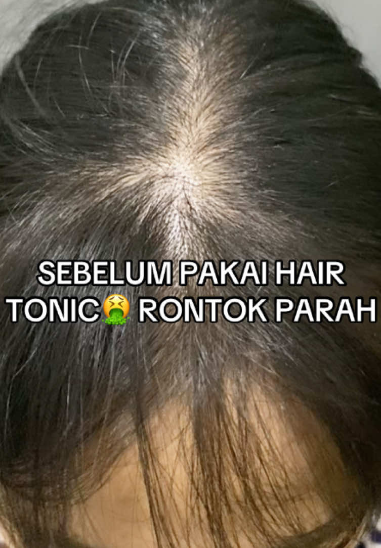 Yuk jangan insecure lagi karna rambut rontok parah, sekarang sudah tersedia solusinya dan terbuat dari bahan alami juga ya😮‍💨🥰#hairtonic #treatment #rambutrontok #rambutmaksimal #obatpenumbuhrambut #solusirambutrontok #rambutlebat #rambutindah #penumbuhrambut #tipsrambutrontok #rontokparah #obatrontok 