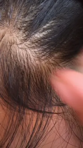 😱😱#omg #lice #liceremoval #satisfatorio #tiktokindia 