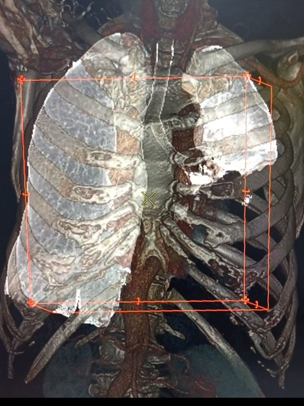 lingkungan tempat tinggal pasien banyak yang merokok, keluhan pasien batuk berdarah #radiologi #ctscan #rokok 
